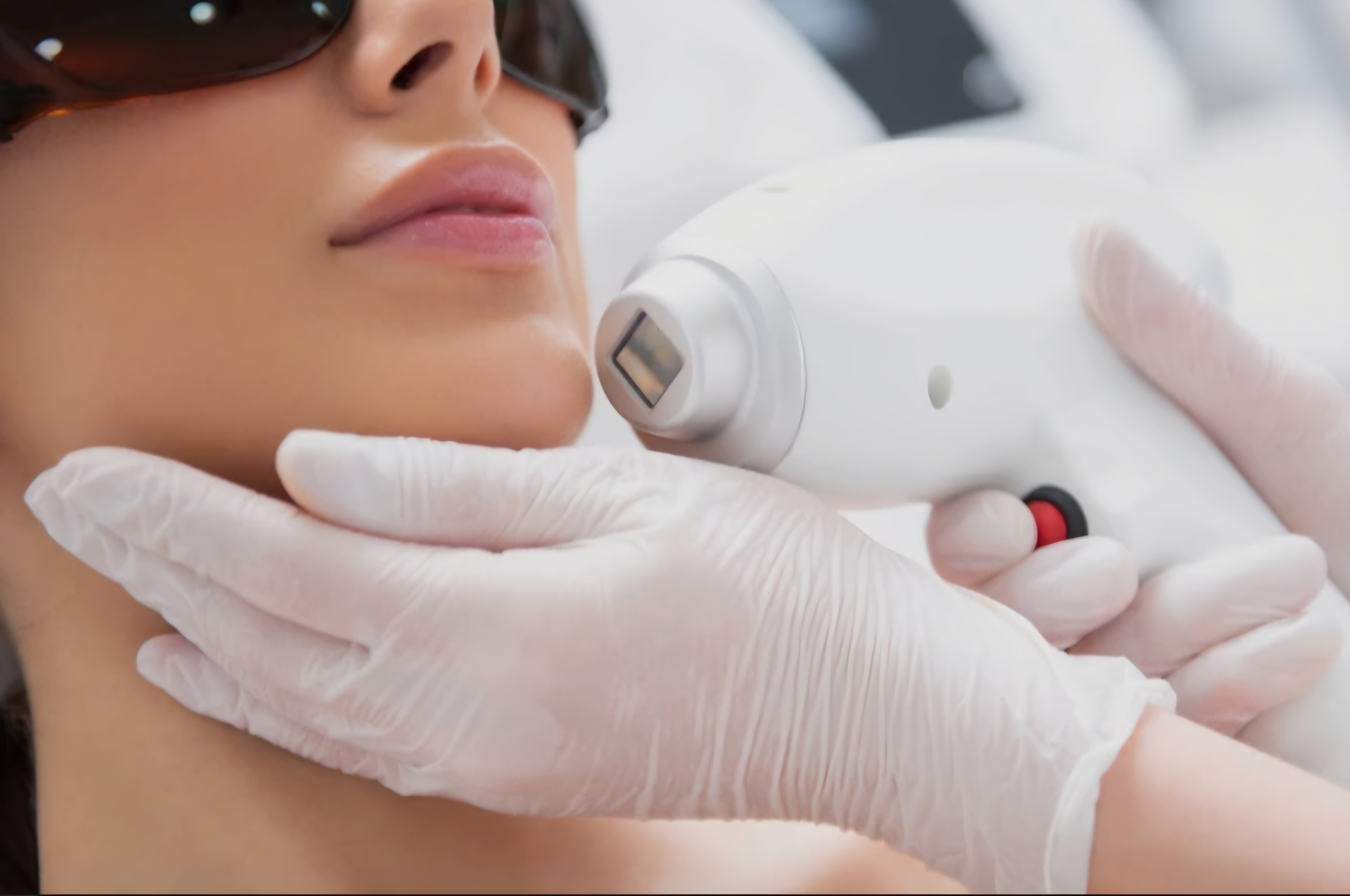 Chin Laser Hair Removal