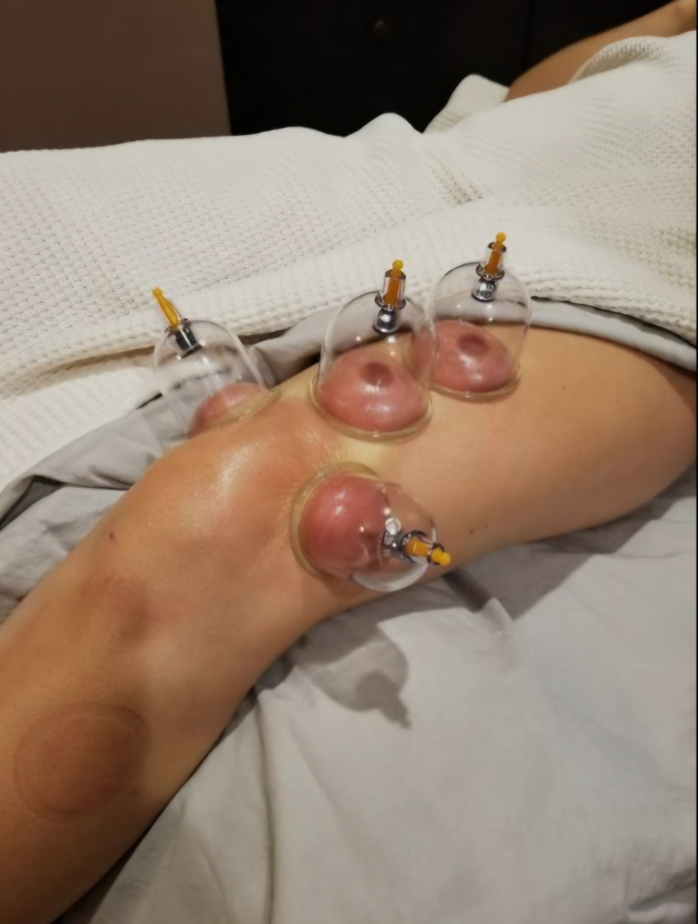 Small Area Cupping Therapy