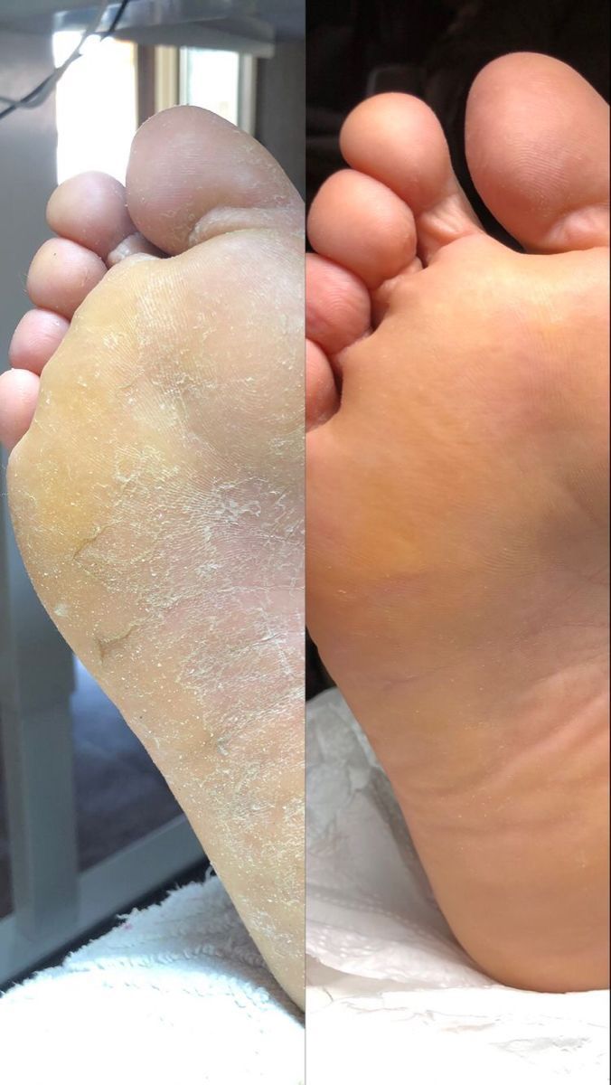 Corn and Callus Removal