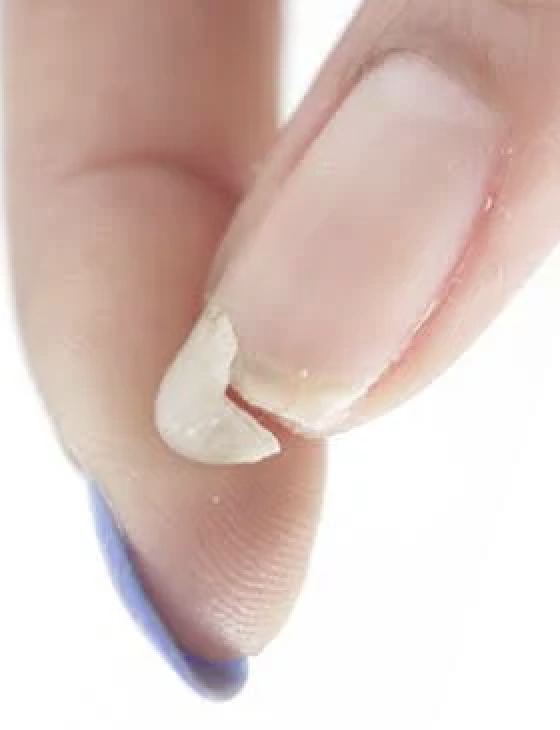 Nail repair
