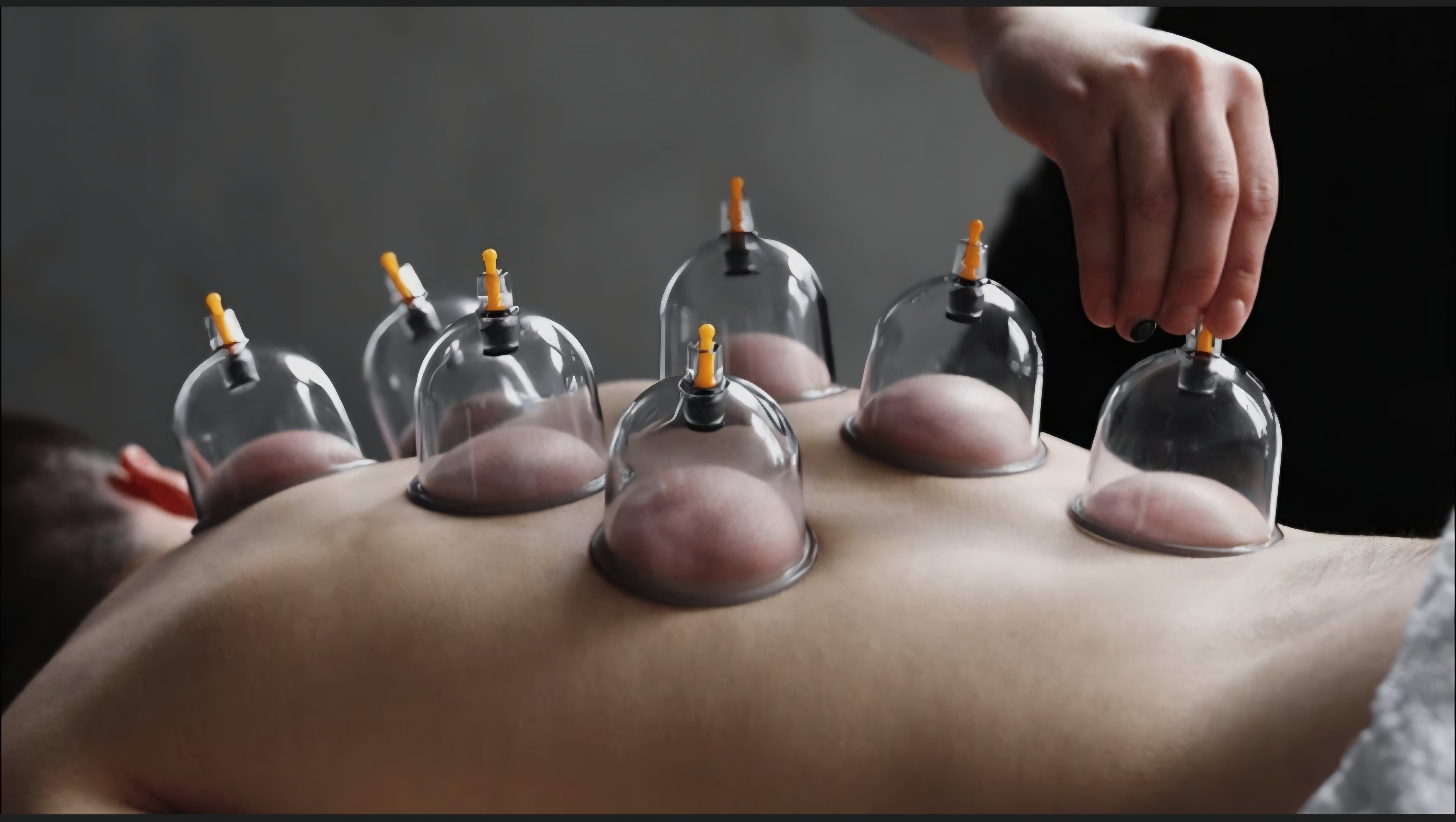 Back cupping Therapy